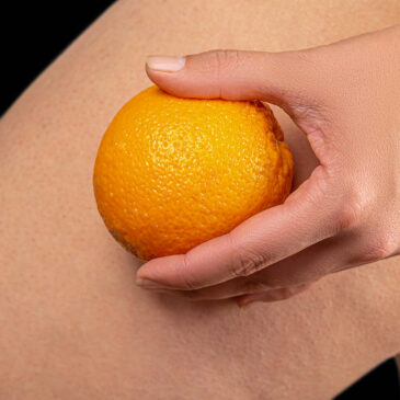 CELLULITE? NO GRAZIE!